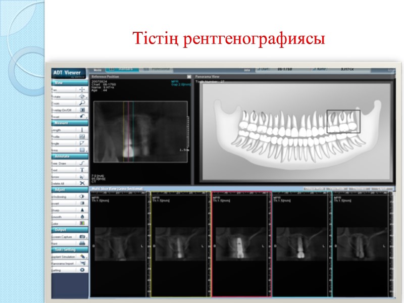 Тістің рентгенографиясы